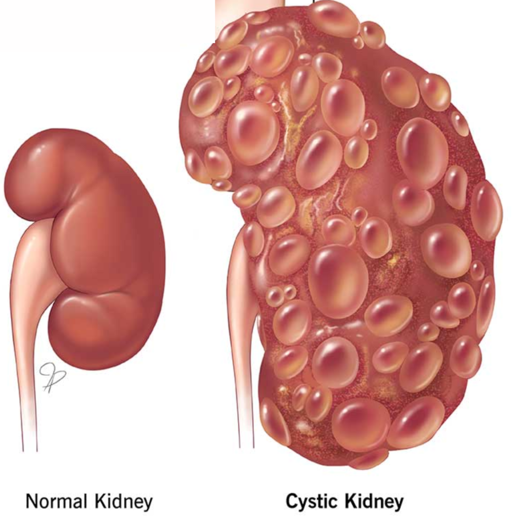 Understanding Cystic Diseases: An Overview